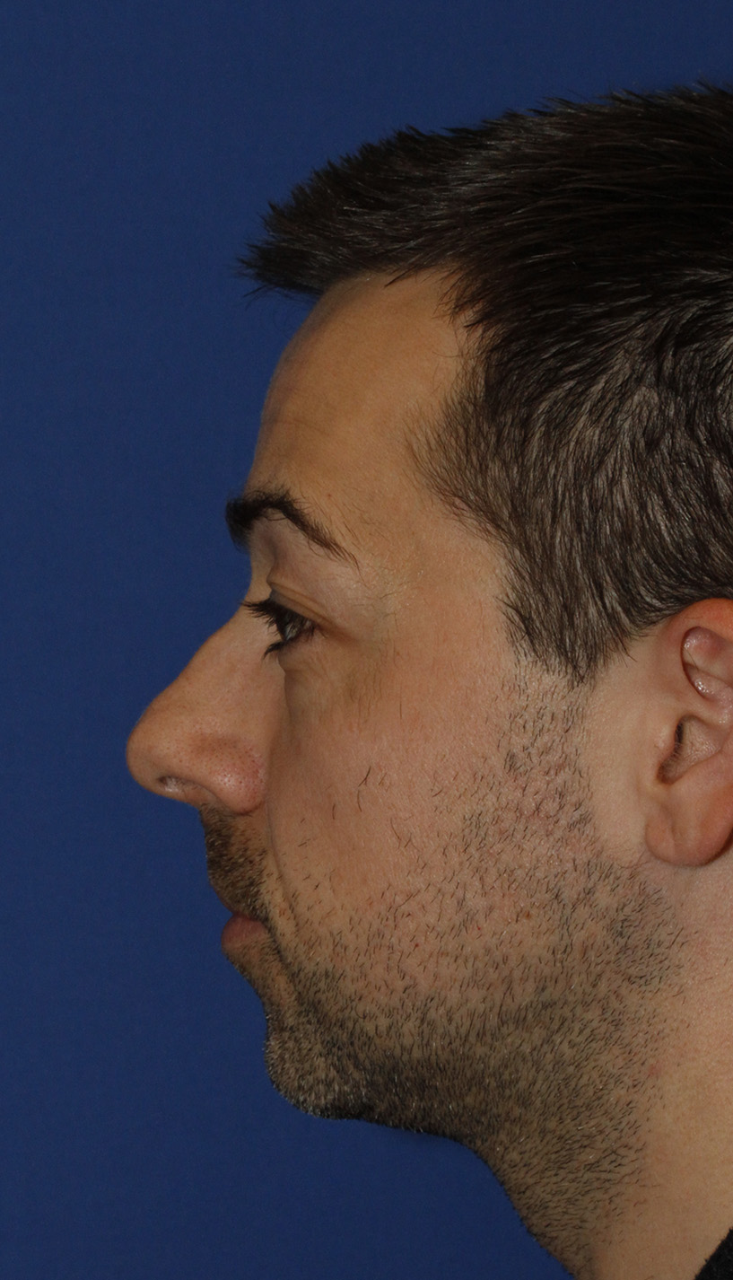 Chin Implant Before L Profile