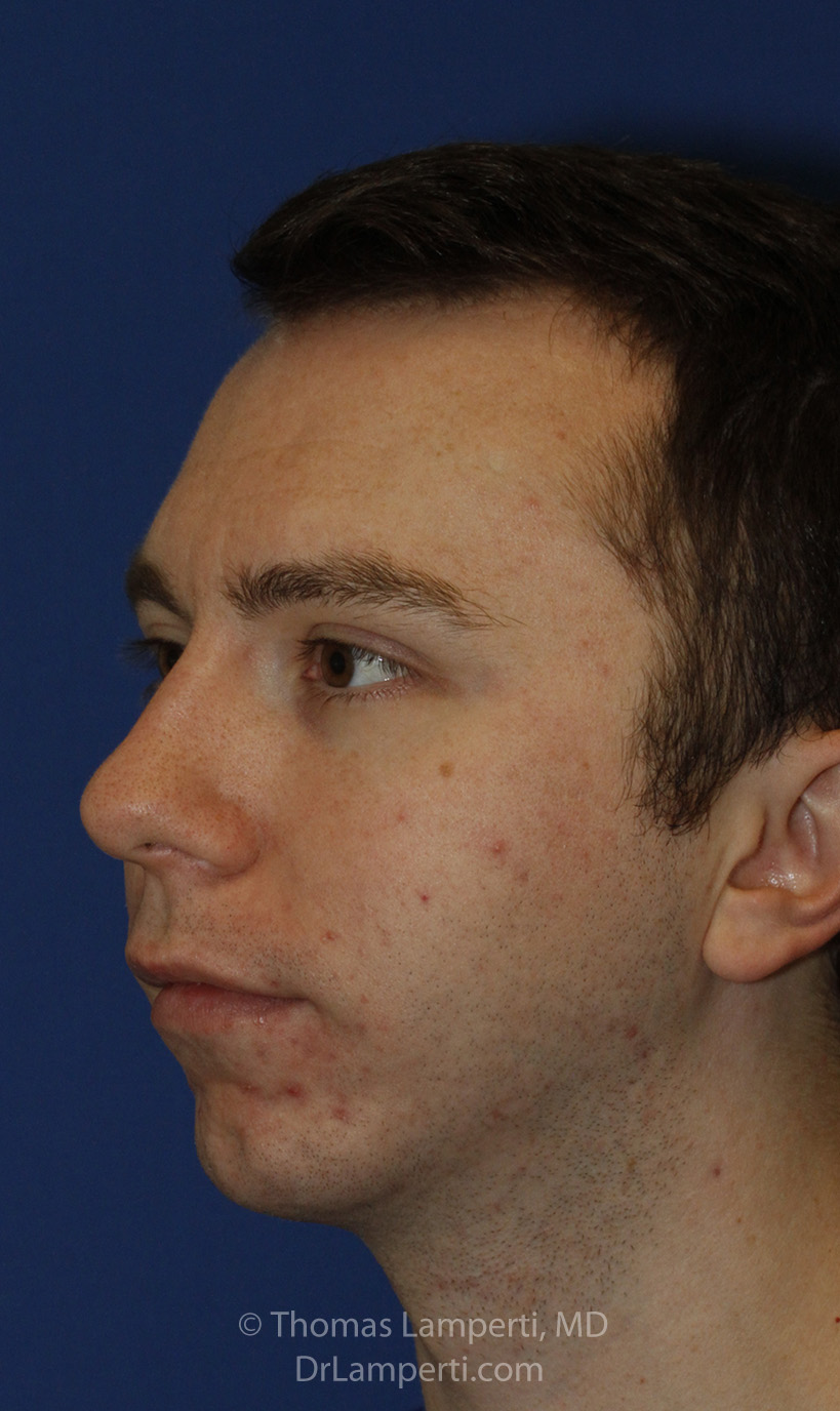 Chin Implant After L Oblique