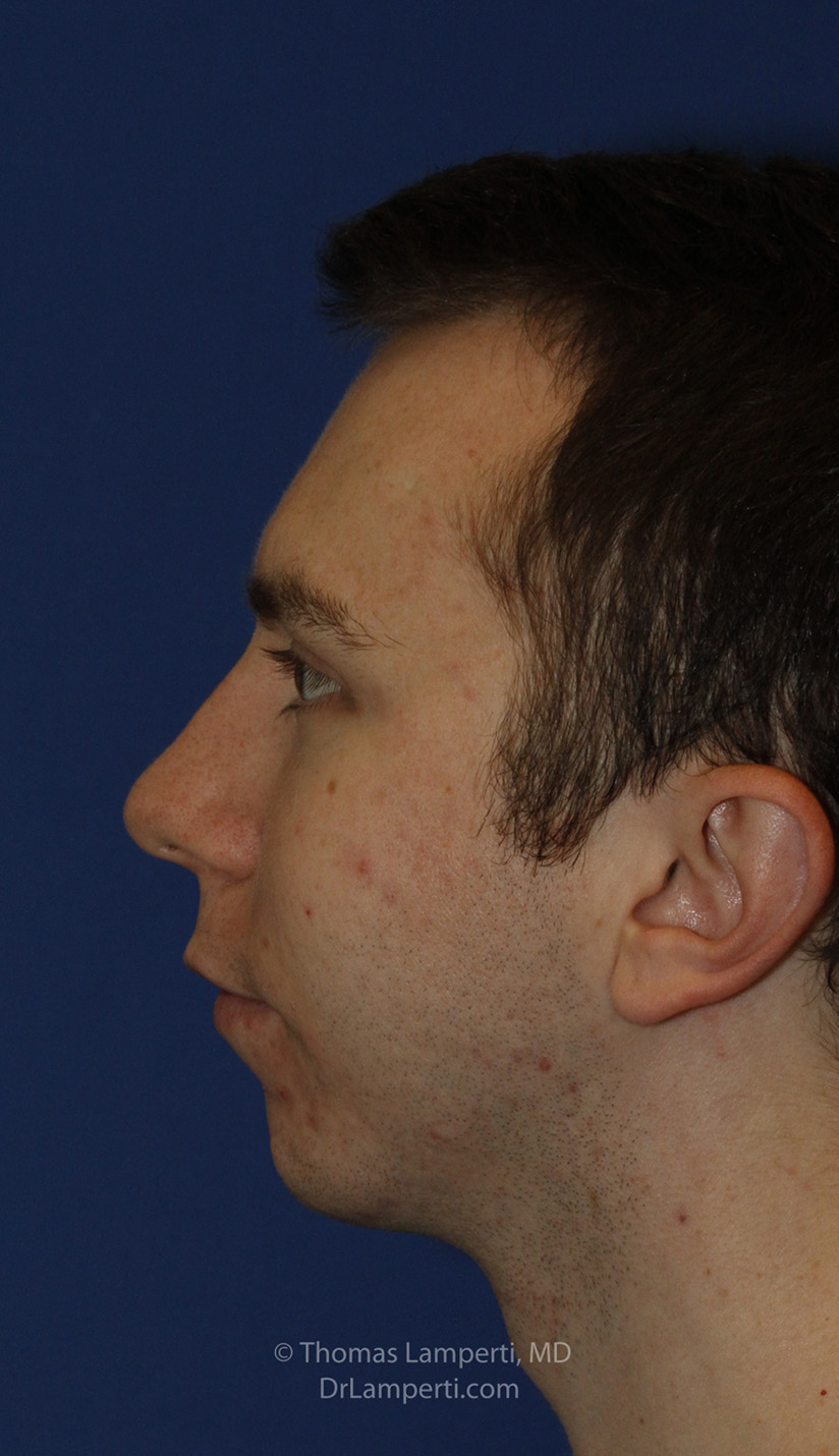 Chin Implant After L Profile