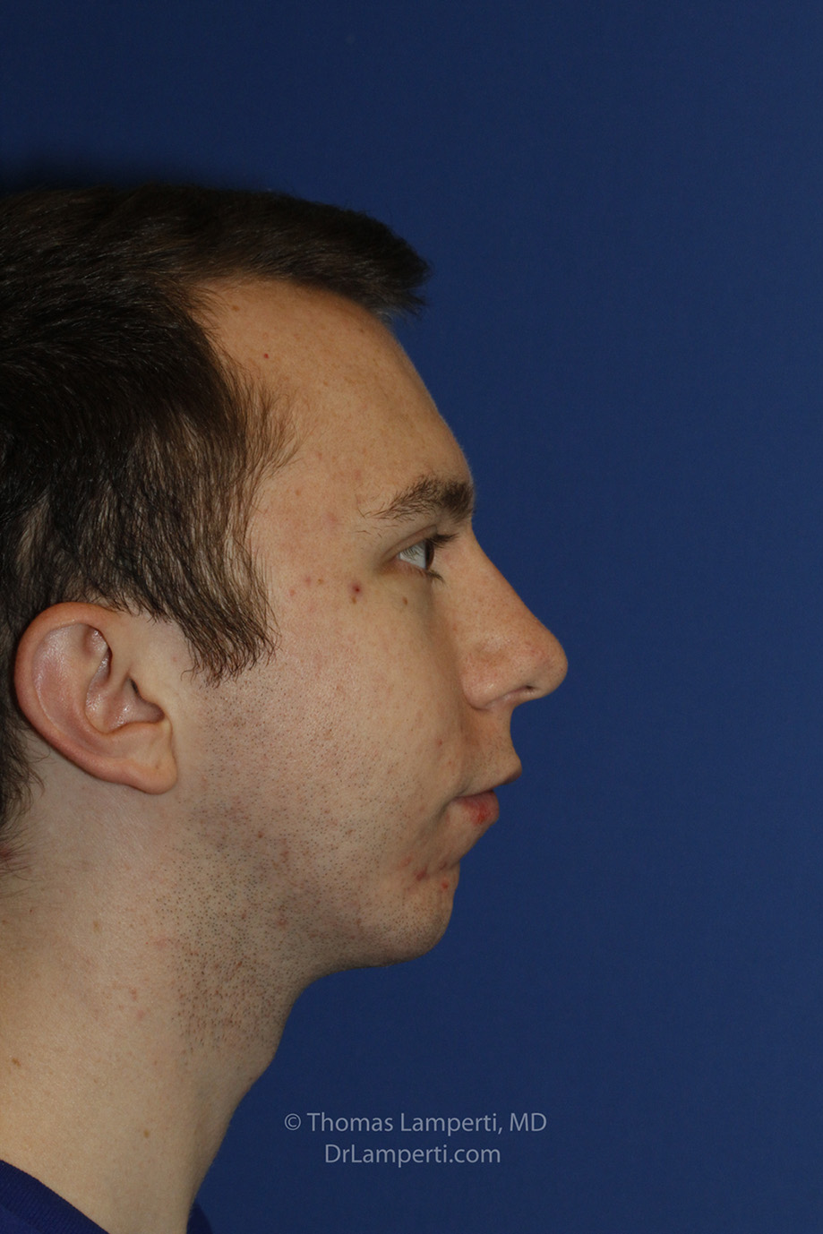 Chin Implant After R Profile