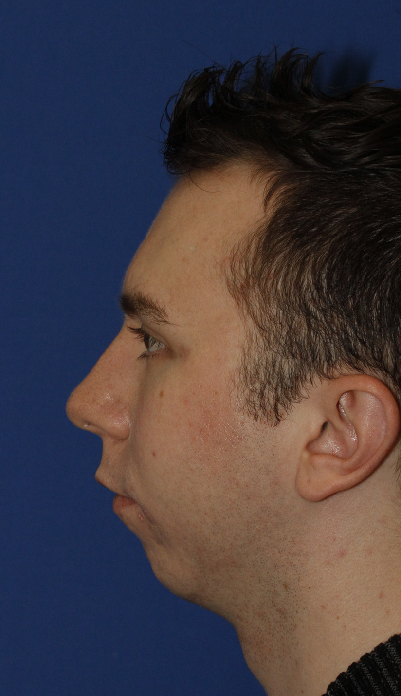 Chin Implant Before L Profile