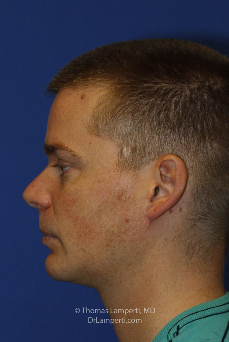 Chin Implant After L Profile