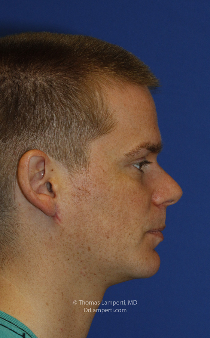 Chin Implant After R Profile