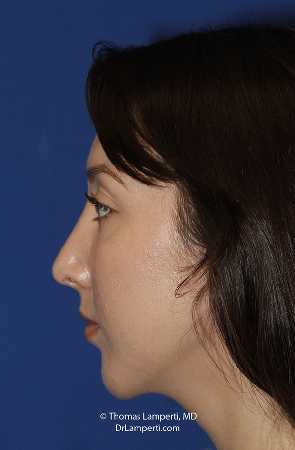 Chin Implant After L Profile