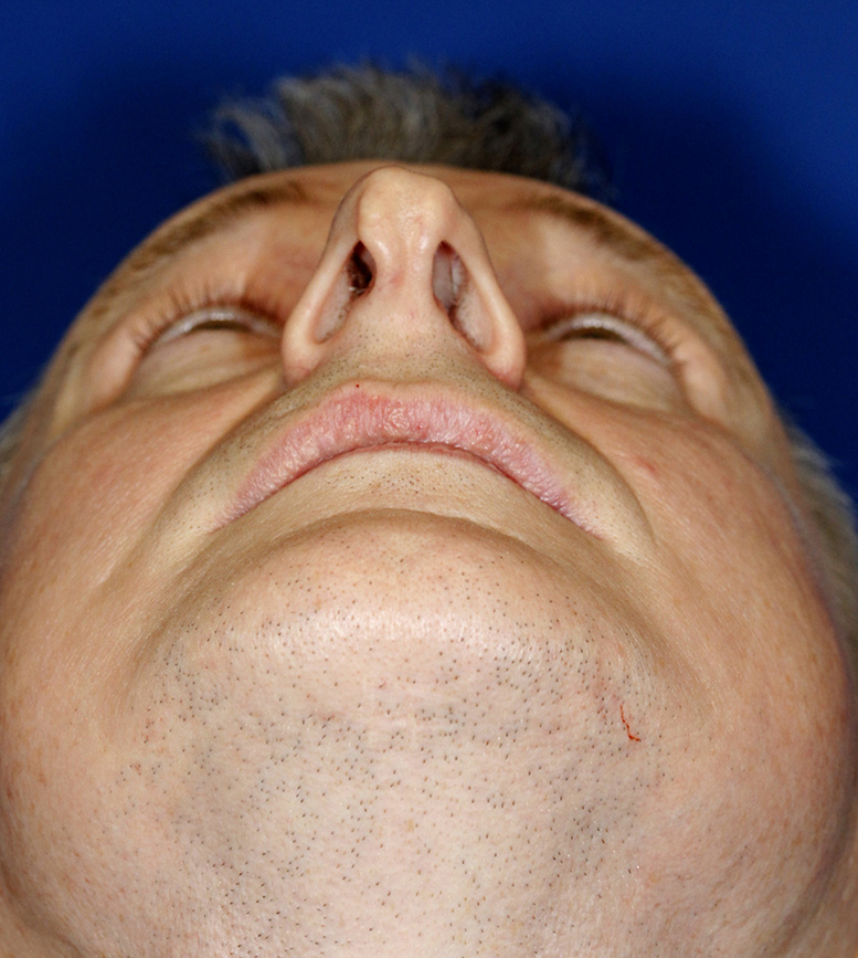 Chin Implant before