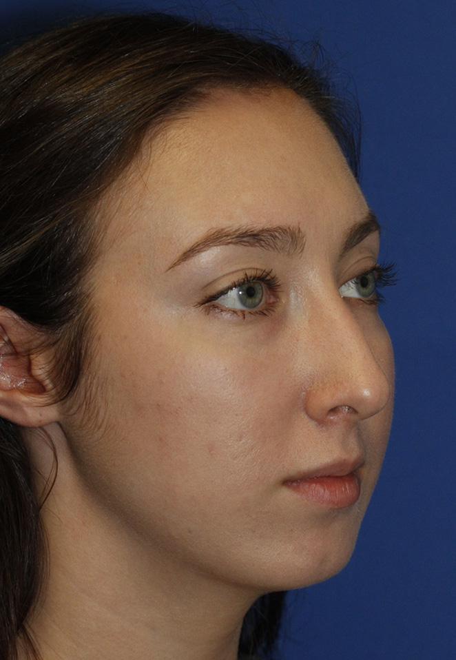 Chin Implant Before R Oblique
