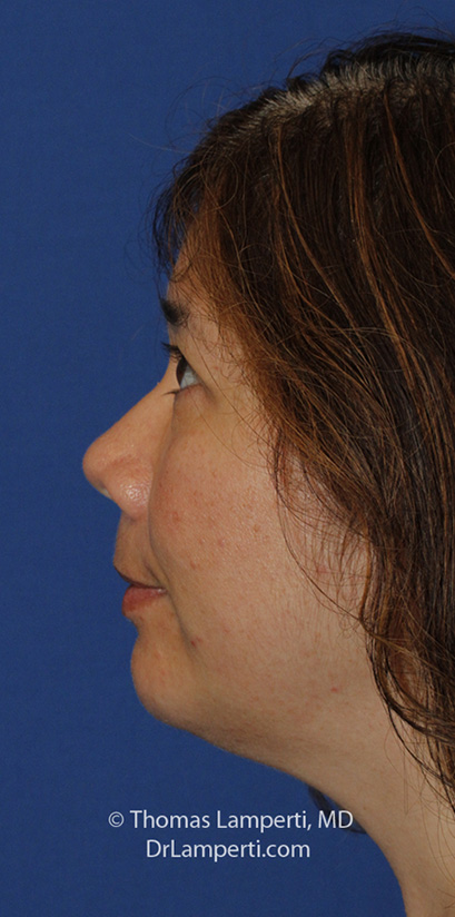 Chin Implant After L Profile