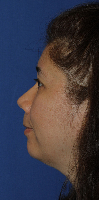 Chin Implant Before L Profile