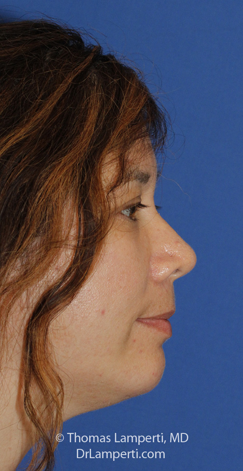 Chin Implant After R Profile