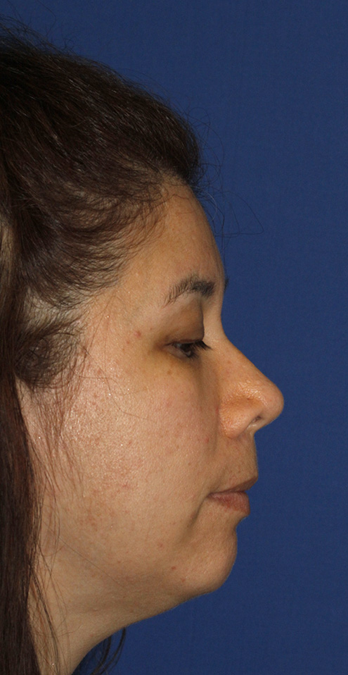 Chin Implant Before R Profile