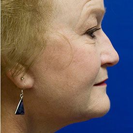 After Facelift Profile