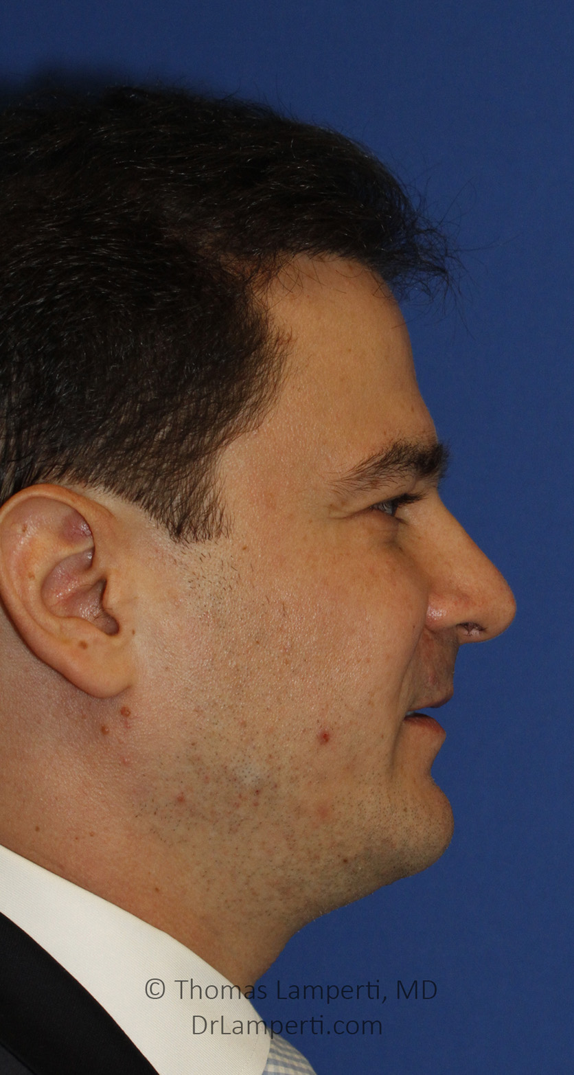 Necklift After R Profile