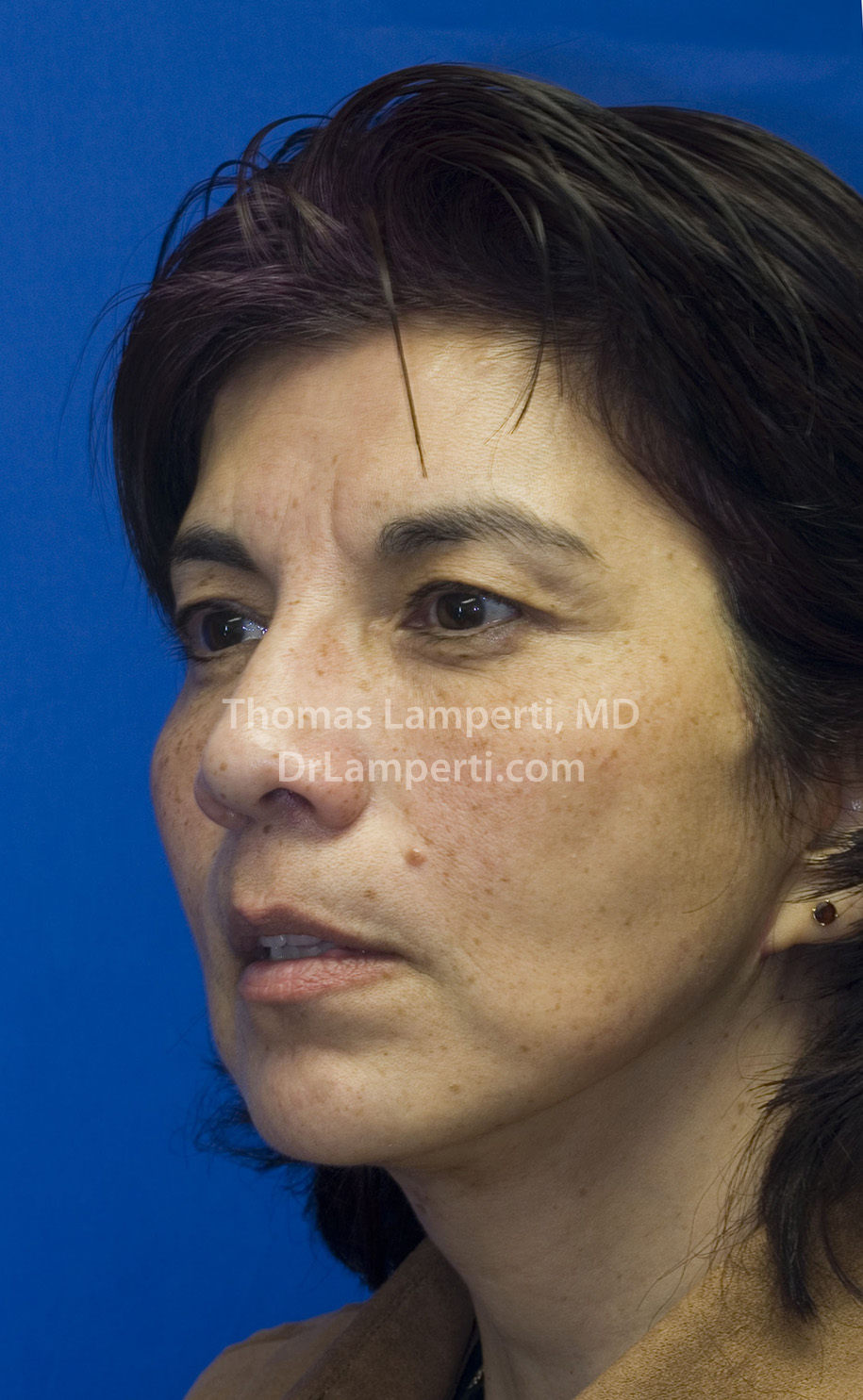 Facelift After L Oblique