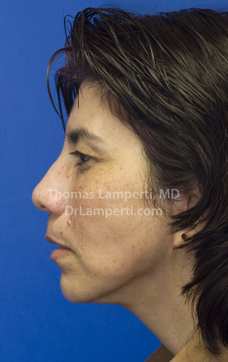 Facelift After L Profile