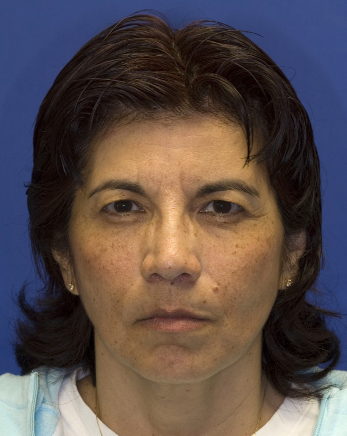 Facelift Before Frontal