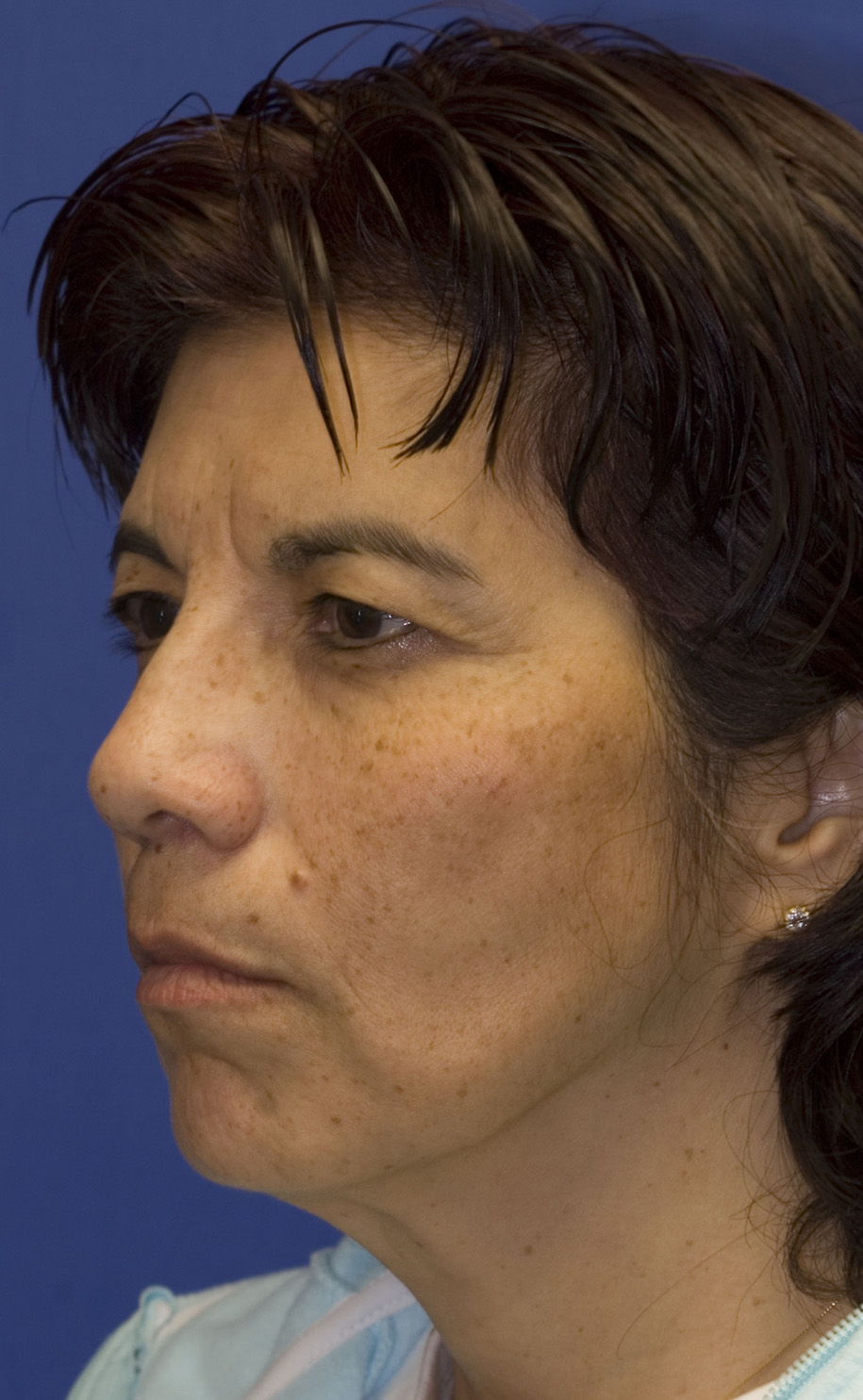 Facelift Before L Oblique