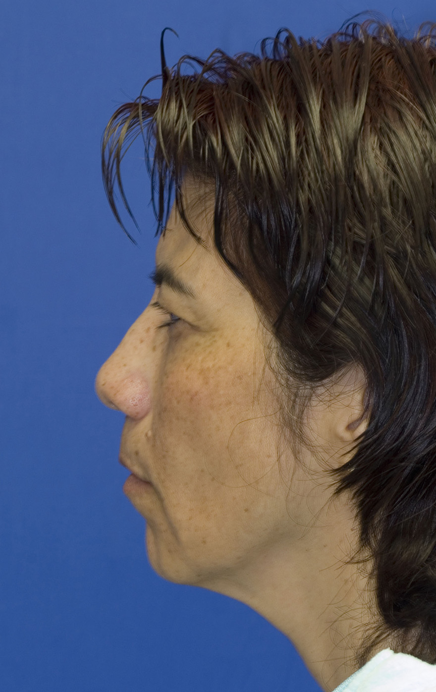 Facelift Before L Profile