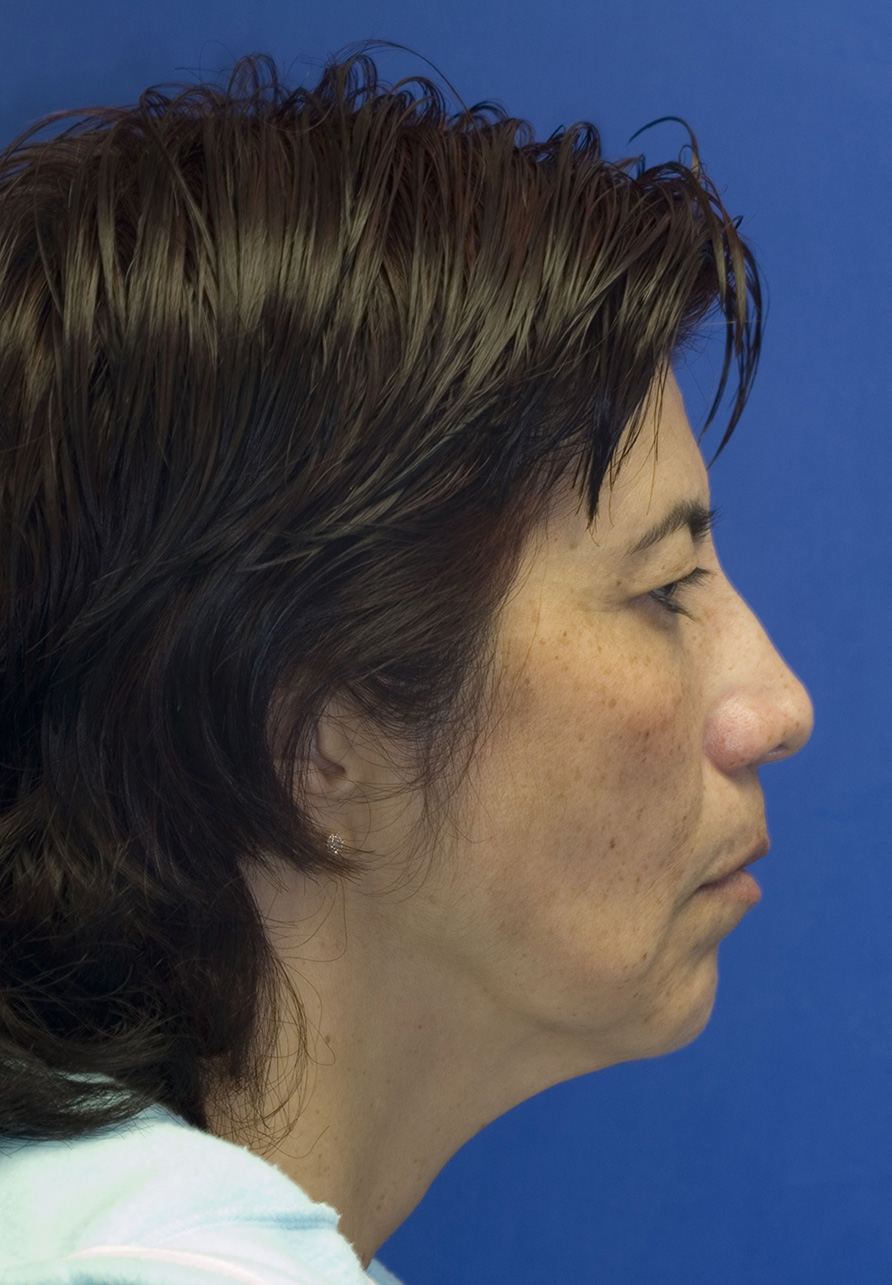 Facelift Before R profile