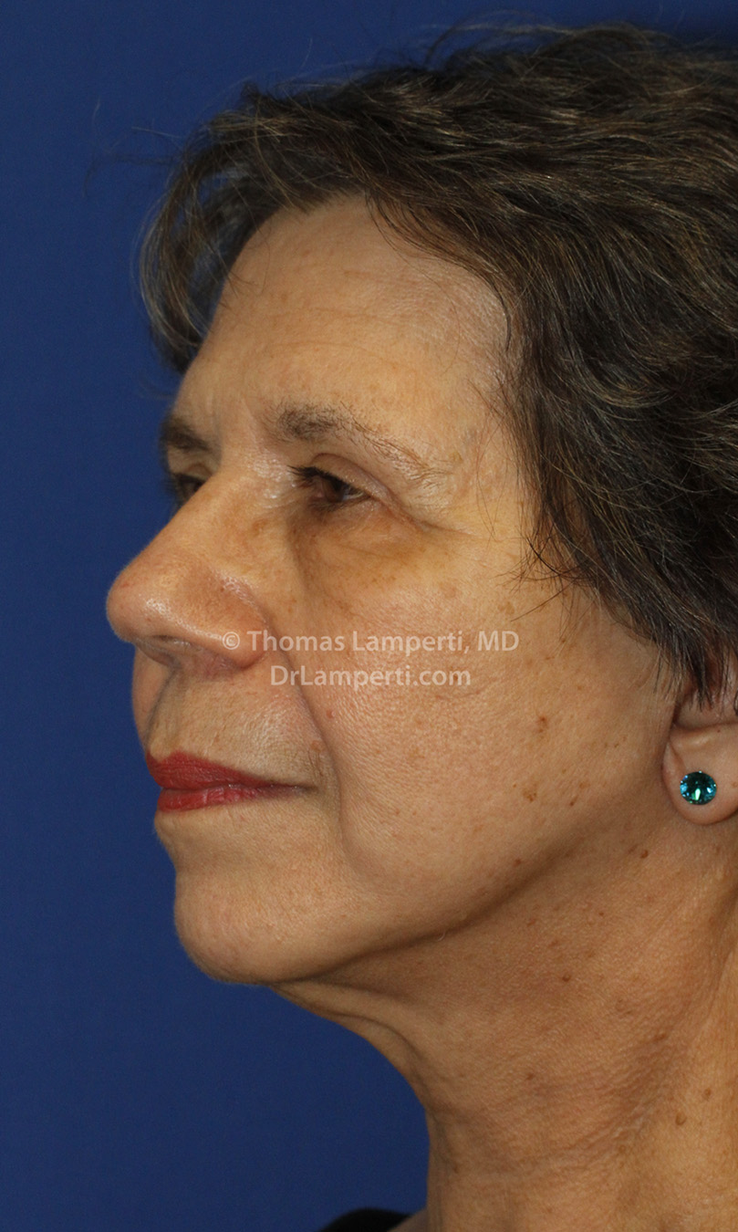 Facelift After L Oblique