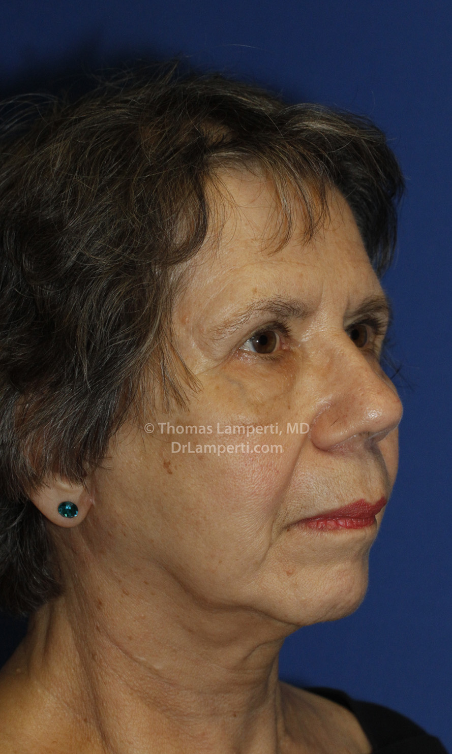 Facelift After R Oblique