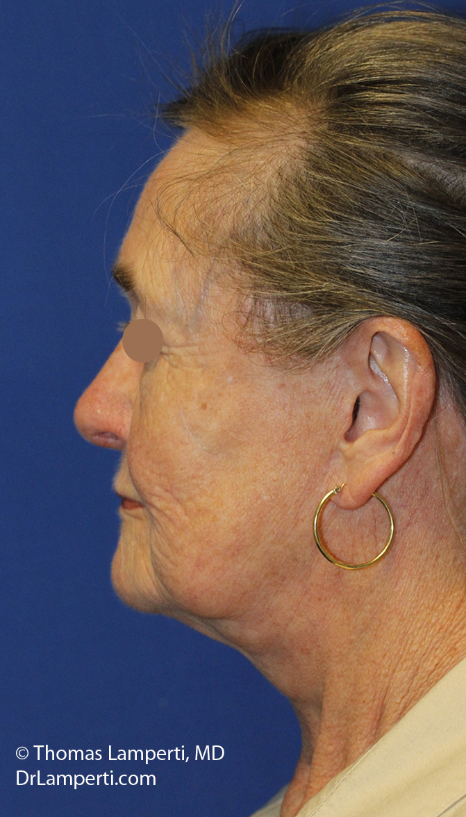 Facelift After L Profile