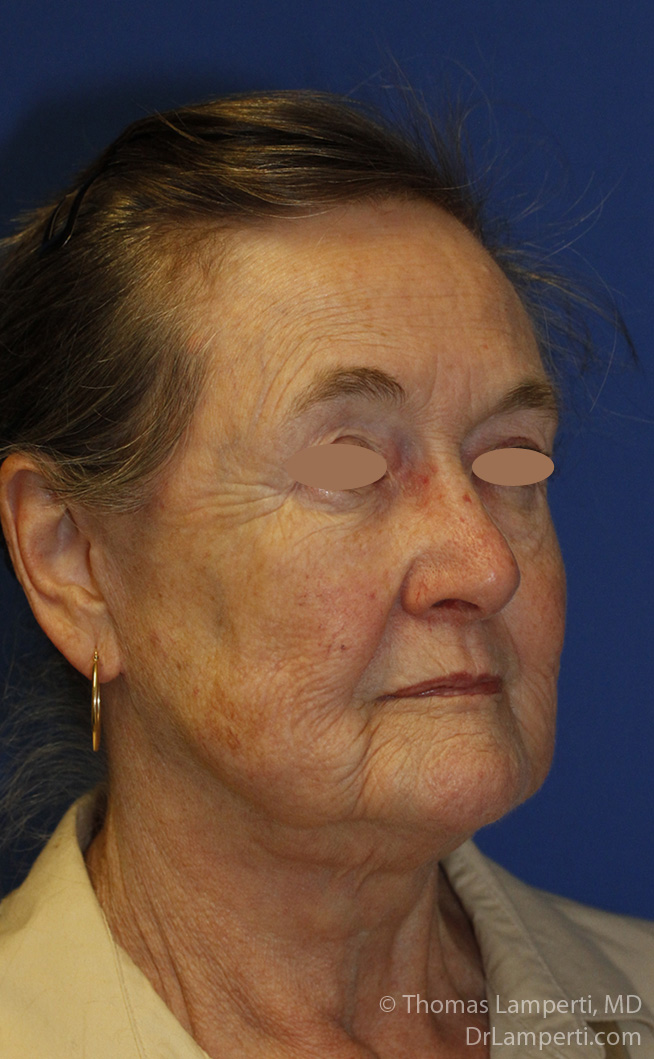 Facelift After R Oblique