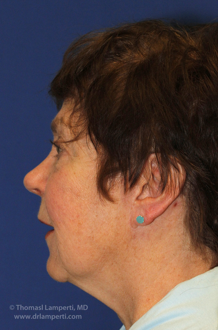 Facelift After L Profile