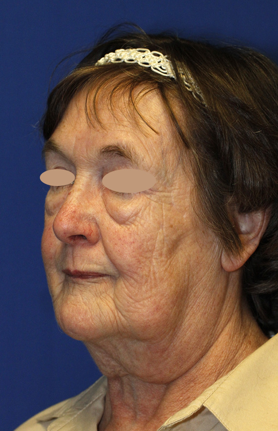 Facelift Before L Oblique