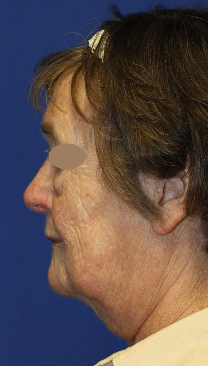 Facelift Before L Profile