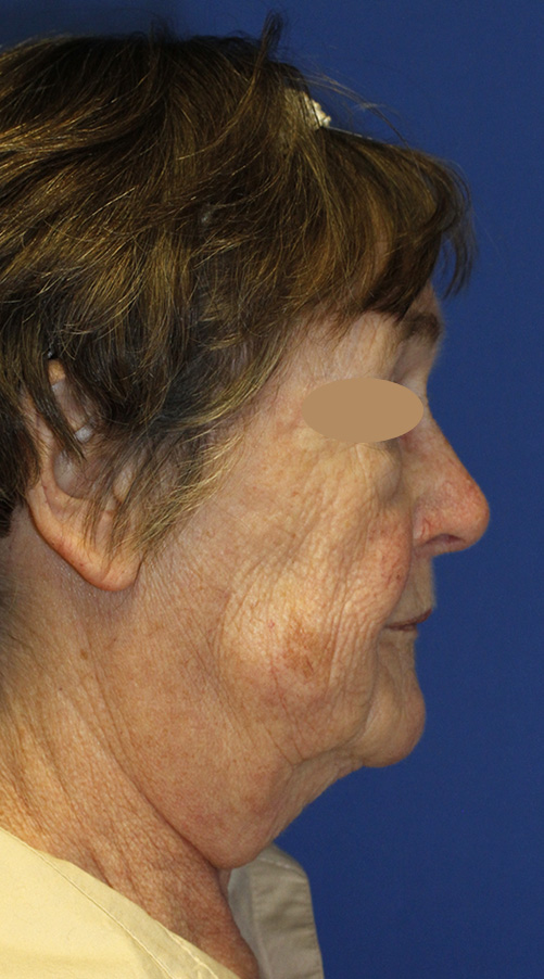 Facelift Before R Profile