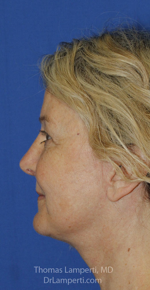 Facelift After L Profile