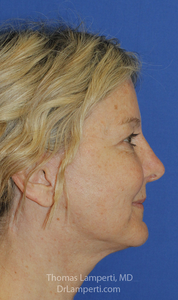 Facelift After R Profile