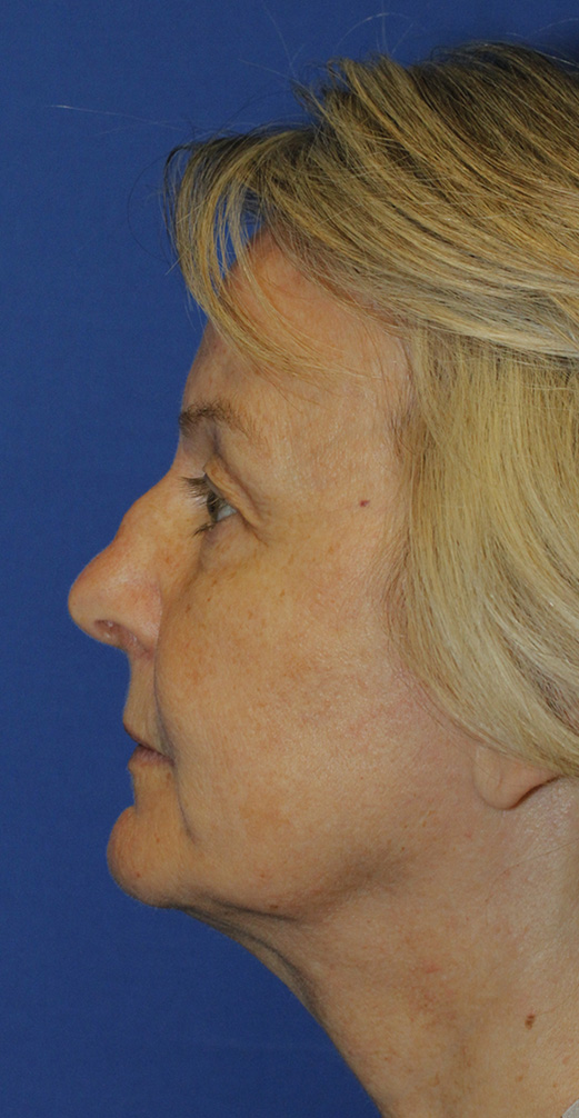 Facelift Before L Profile