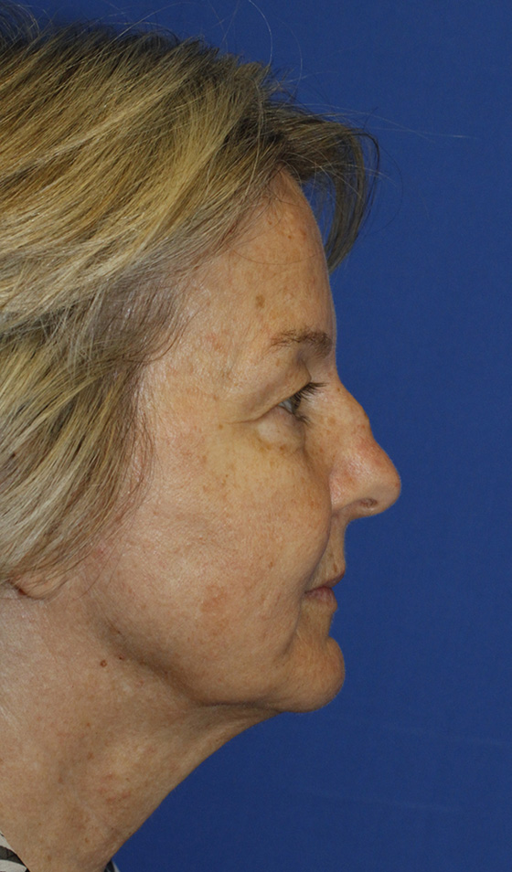 Facelift Before R Profile