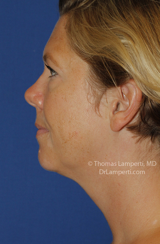 Neck Lift After L Profile