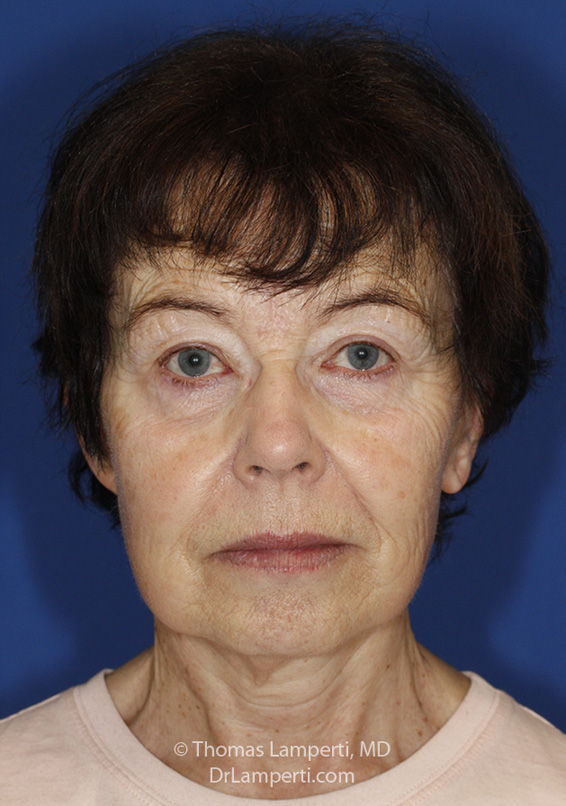 Facelift After Frontal