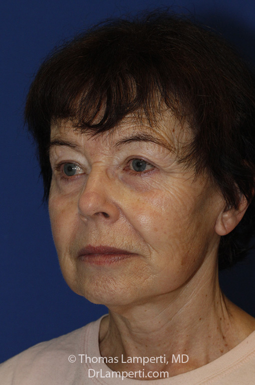 Facelift After L Oblique