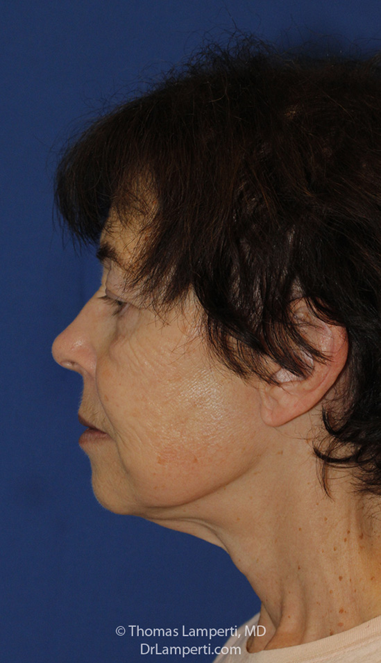 Facelift After L Profile