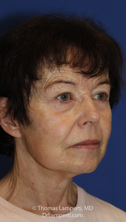 Facelift After R Oblique