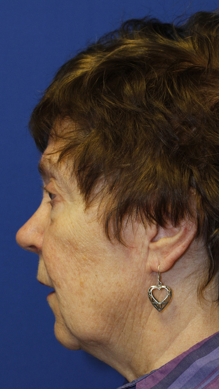 Facelift Before L Profile