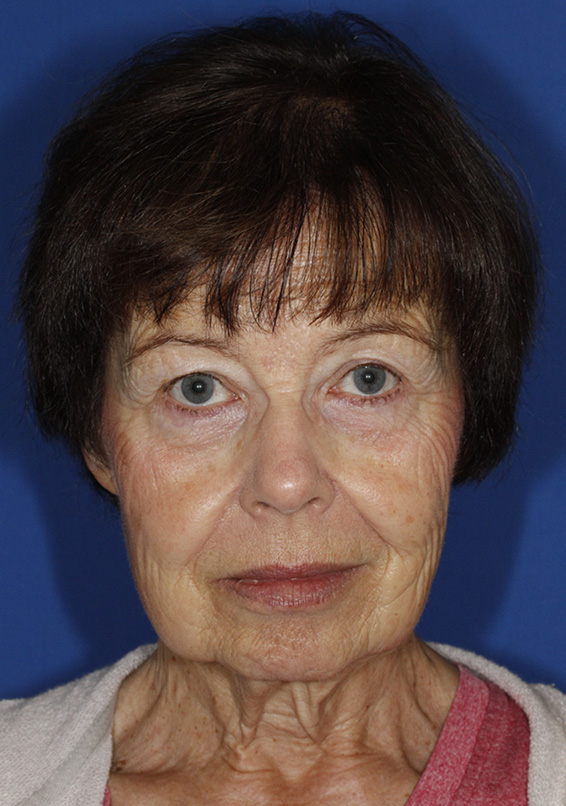 Facelift Before Frontal