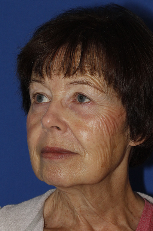 Facelift Before L Oblique