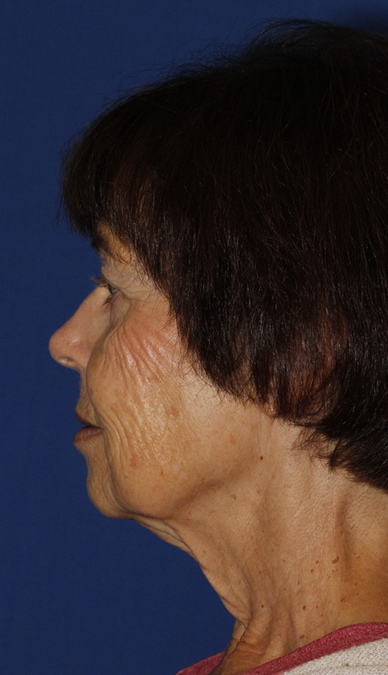 Facelift Before L Profile