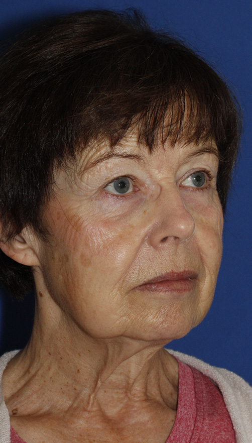 Facelift Before R Oblique