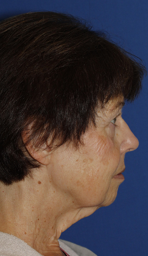 Facelift Before R Profile