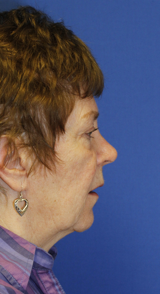 Facelift Before R Profile