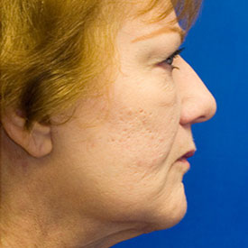 After Fat Grafting Profile