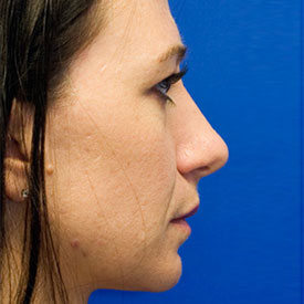 Before Fat Grafting Profile