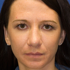 After Fat Grafting Frontal
