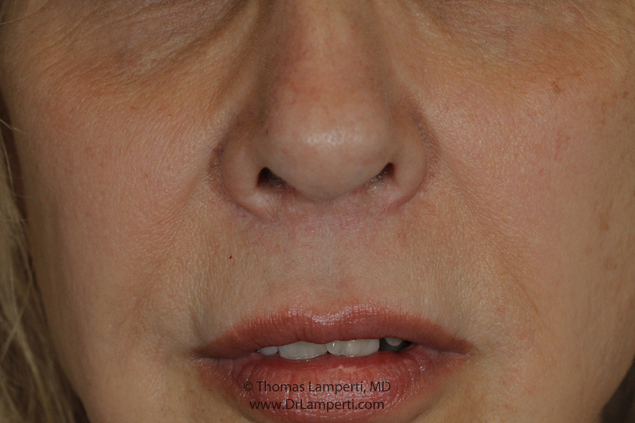 Upper Lip Lift Healed Incision